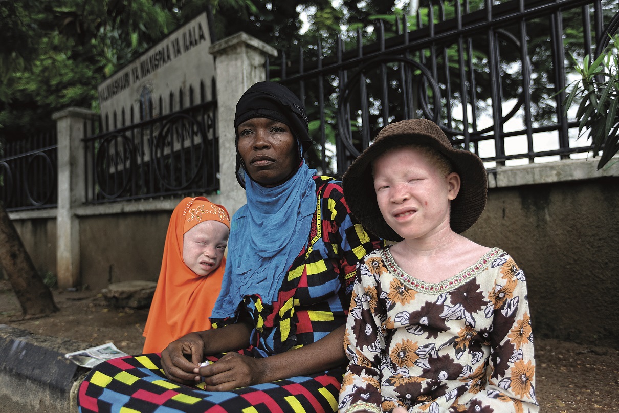 Afrikalı Albinoların Yaşamı İKÜSAG’DA